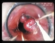 Tratament endoscopic hemoroizi