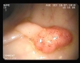 Polip pediclat colonic