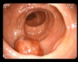 Polip sesil colonic