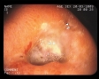 Ulcer duodenal activ