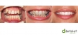 Ortodontie, aparat dentar fix ceramic