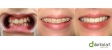 Ortodontie, aparat dentar fix ceramic