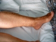 Cicatrice dupa operatie de varice. Pete maronii picior stang