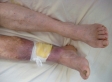 Ulcer varicos gamba dreapta