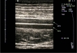 Ecografie Doppler vasculara. Artera femurala. Vena femurala 