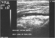 Ecografie Doppler vasculara. Artera poplitee