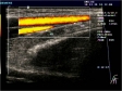 Ecografie Doppler vasculara. Artera brahiala. Vena brahiala