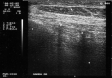 Ecografie Doppler vasculara. Mediocalcinoza