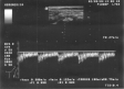 Ecografie Doppler vasculara. Artera vertebrala