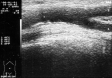 Ecografie Doppler vasculara. Ateroscleroza femurala