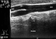 Ecografie Doppler vasculara. Ateroscleroza carotidiana