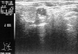 Ecografie Doppler vasculara. Ateroscleroza carotidiana