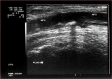 Ecografie Doppler vasculara. Ateroscleroza femurala