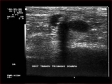 Ecografie Doppler vasculara. Ateroscleroza femurala