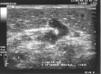 Ecografie Doppler vasculara. Venele musculare. Perforanta