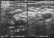 Ecografie Doppler vasculara. Tromboza venoasa profunda acuta