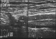 Ecografie Doppler vasculara. Tromboza venoasa profunda acuta