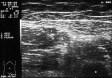 Ecografie Doppler vasculara. Tromboza venoasa profunda acuta