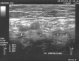 Ecografie Doppler vasculara. Tromboza venoasa profunda acuta