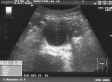 Ecografie Doppler vasculara. Anevrism aortic.. Tromboza