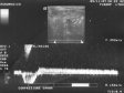 Ecografie Doppler vasculara. Sindrom posttrombotic