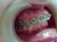 Aparat ortodontic Damon