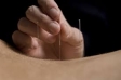 Acupunctura (3)